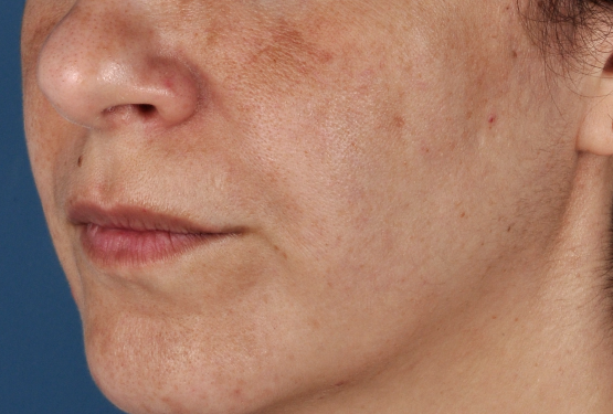 Melasma