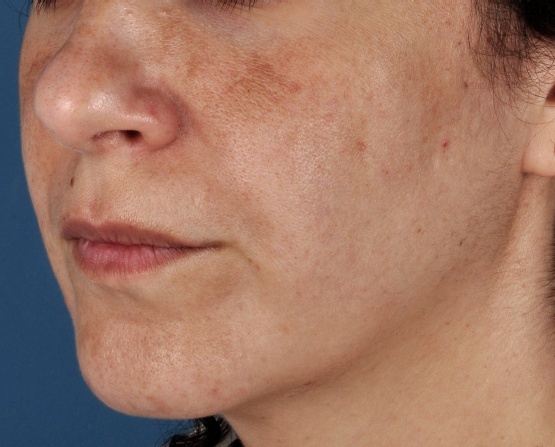 Melasma