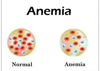 Anemia
