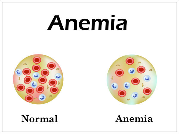 Anemia