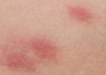 Skin Rash