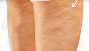 Cellulite Causes, Symptoms, Diagnosis and Treatment
