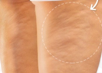 Cellulite Causes, Symptoms, Diagnosis and Treatment