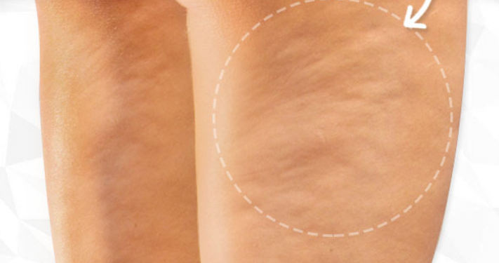 Cellulite Causes, Symptoms, Diagnosis and Treatment