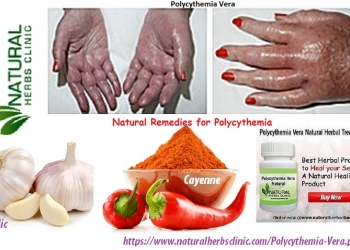 Natural Remedies for Polycythemia Vera