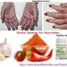 Natural Remedies for Polycythemia Vera