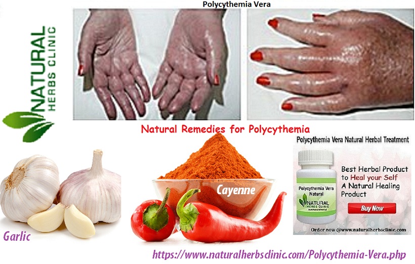 Natural Remedies for Polycythemia Vera