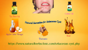 Natural Remedies for Sebaceous Cyst