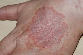 Granuloma Annulare 4