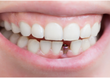 5 Reasons Why People Need to Have Dental Implants