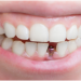 5 Reasons Why People Need to Have Dental Implants