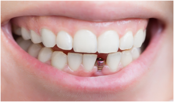 5 Reasons Why People Need to Have Dental Implants