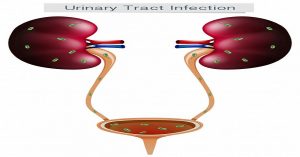 Bladder cancer