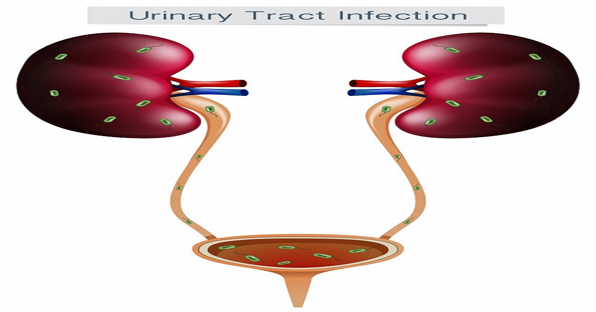 Bladder cancer