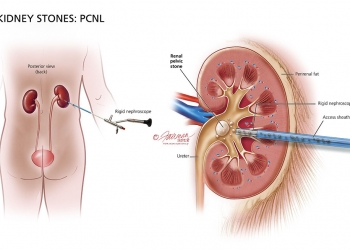 Know the Kidney Stones Treatment and Prevention