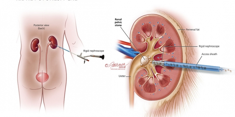 Know the Kidney Stones Treatment and Prevention