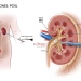 Know the Kidney Stones Treatment and Prevention