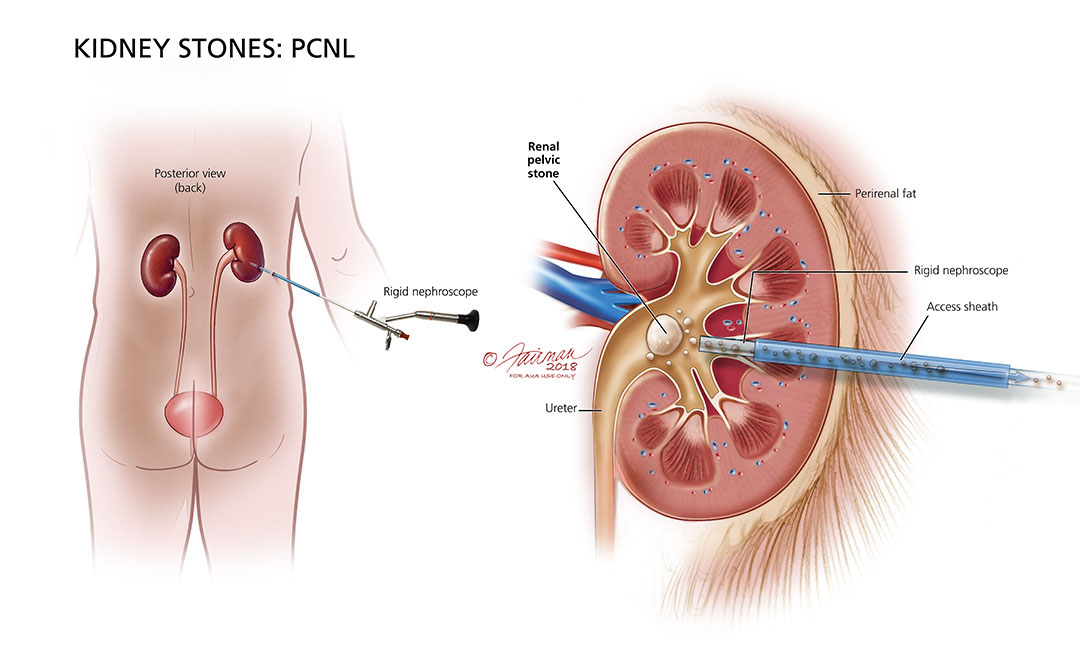 Know the Kidney Stones Treatment and Prevention