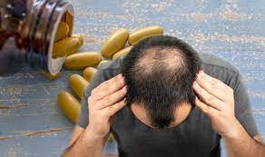 Top 4 Herbal Supplement for Alopecia Treatment