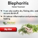 Herbal Treatment For Blepharitis