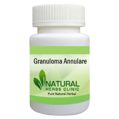 Natural Remedies for Granuloma Annulare