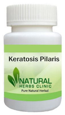 Keratosis Pilaris Herbal Treatment