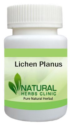 Lichen Planus Herbal Treatment
