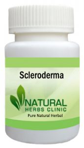 Scleroderma