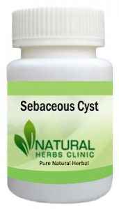 Natural Remedies for Sebaceous Cyst