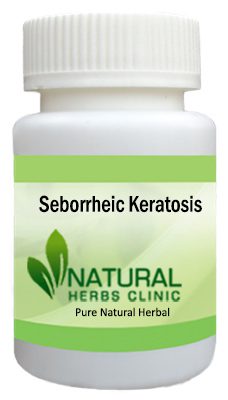 Seborrheic Keratosis