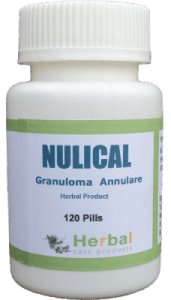 Granuloma-Annulare-Symptoms-Causes-and-Treatment-228x400