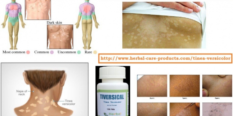 Herbal Supplement for Tinea Versicolor