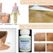 Herbal Supplement for Tinea Versicolor