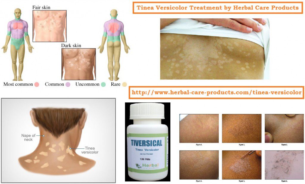 Herbal Supplement for Tinea Versicolor