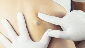 Sebaceous Cyst
