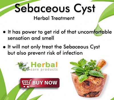 Herbal Supplement for Sebaceous Cyst