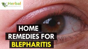 How to Cure Blepharitis Naturally with Home Remedies!