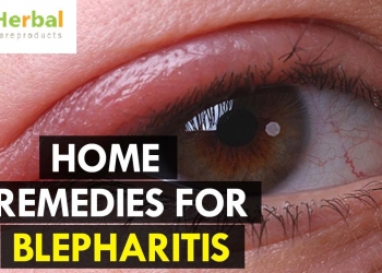 How to Cure Blepharitis Naturally with Home Remedies!