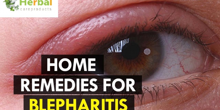 How to Cure Blepharitis Naturally with Home Remedies!