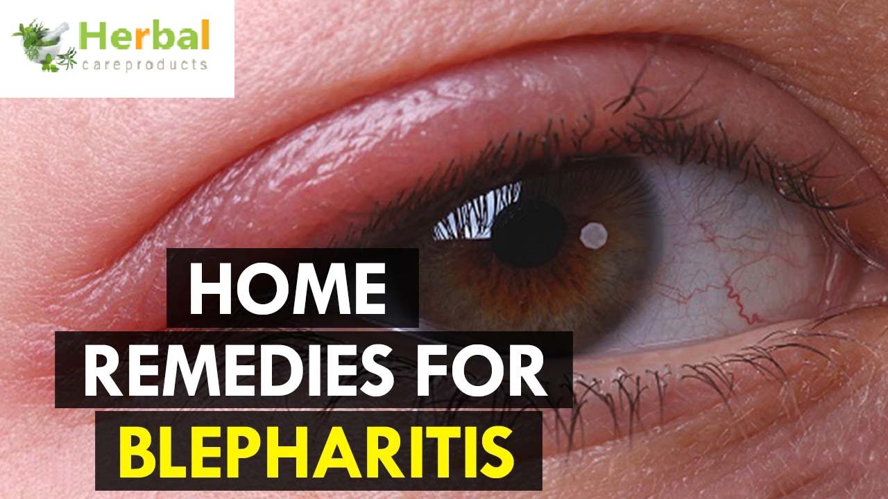 How to Cure Blepharitis Naturally with Home Remedies!