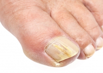 How to Get Rid of Tinea Unguium in Just 3 Easy Steps!
