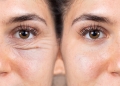Natural Treatment for Under Eye Bags and Wrinkles