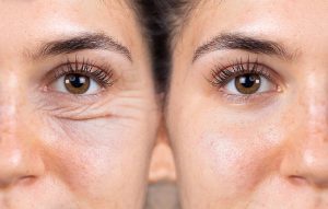 Natural Treatment for Under Eye Bags and Wrinkles