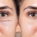 Natural Treatment for Under Eye Bags and Wrinkles