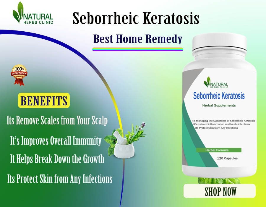 Seborrheic Keratosis Natural Remedies