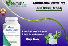 Granuloma Annulare Herbal Treatment