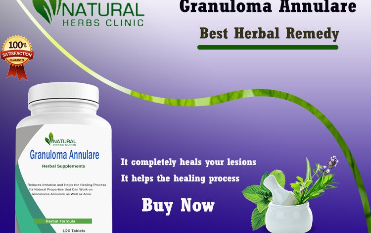 Granuloma Annulare Herbal Treatment