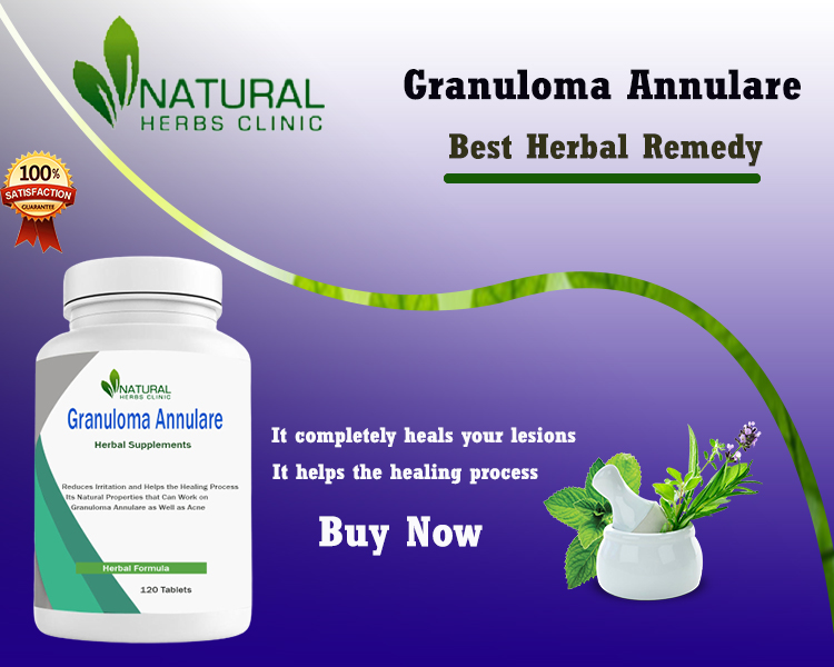 Granuloma Annulare Herbal Treatment