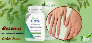 Natural Treatment for Eczema