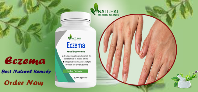 Natural Treatment for Eczema